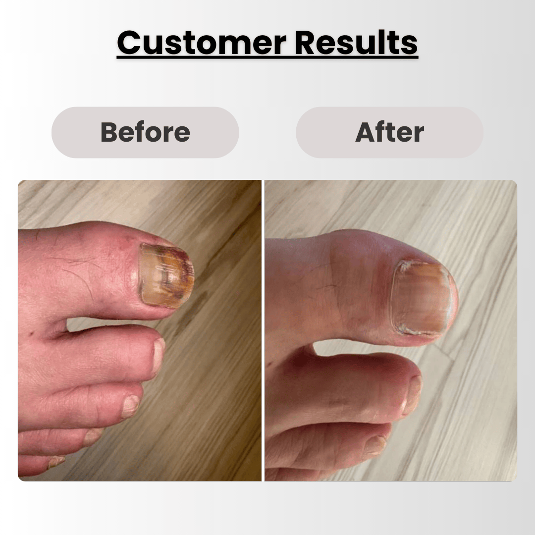 NailHealth® CuraNail Pro