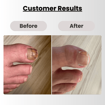 NailHealth® CuraNail Pro