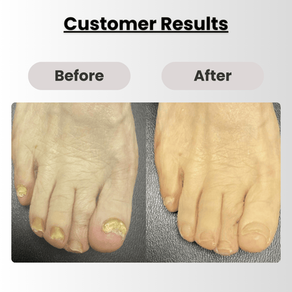NailHealth® CuraNail Pro